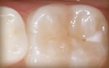 Tooth Cavity Before Sealant Applied